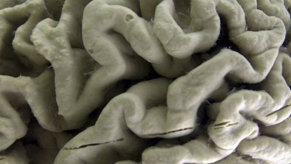 A subset of Alzheimer's cases may be caused by two copies of a single gene, new research shows
